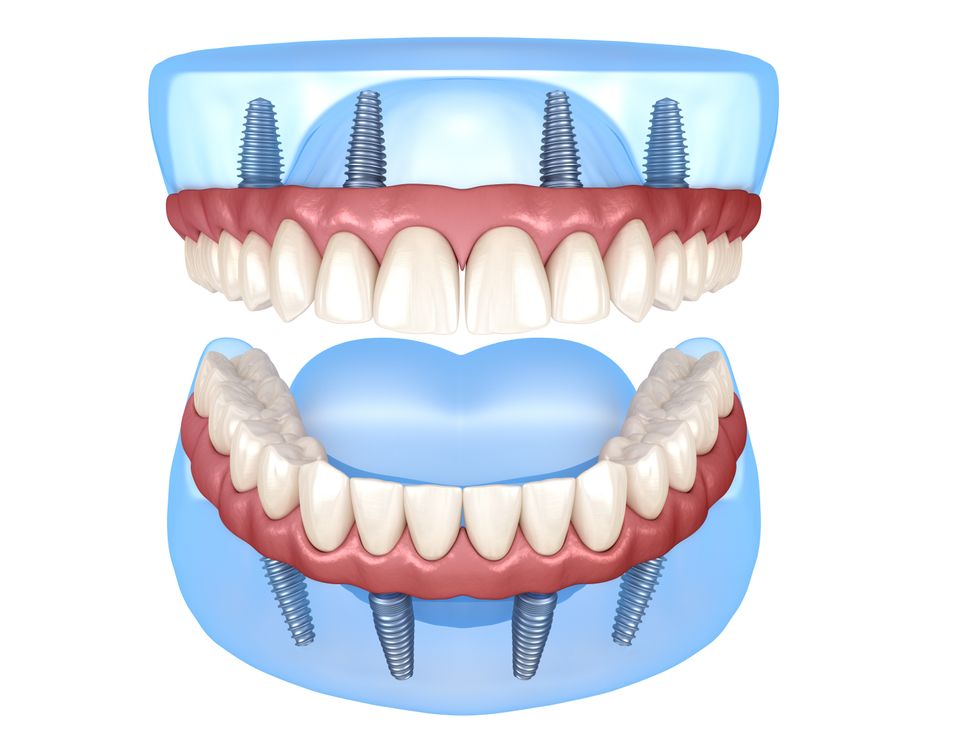 implantacion